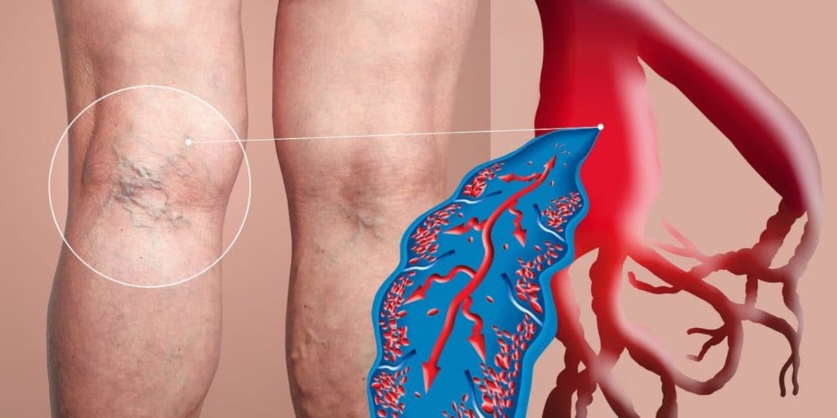 پاورپوینت DVT ترمبوز وریدی