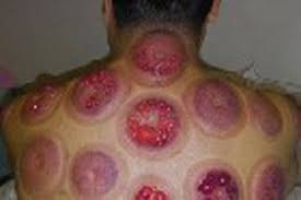 پاورپوینت حجامت