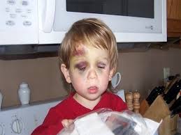 پاورپوینت بیماری های خون در کودکان هموفیلی و لوسمی (ppt) 16 اسلاید